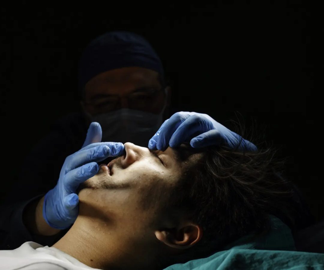 Rinoplastia, operación quirúrgica de la nariz.Resat Dongel